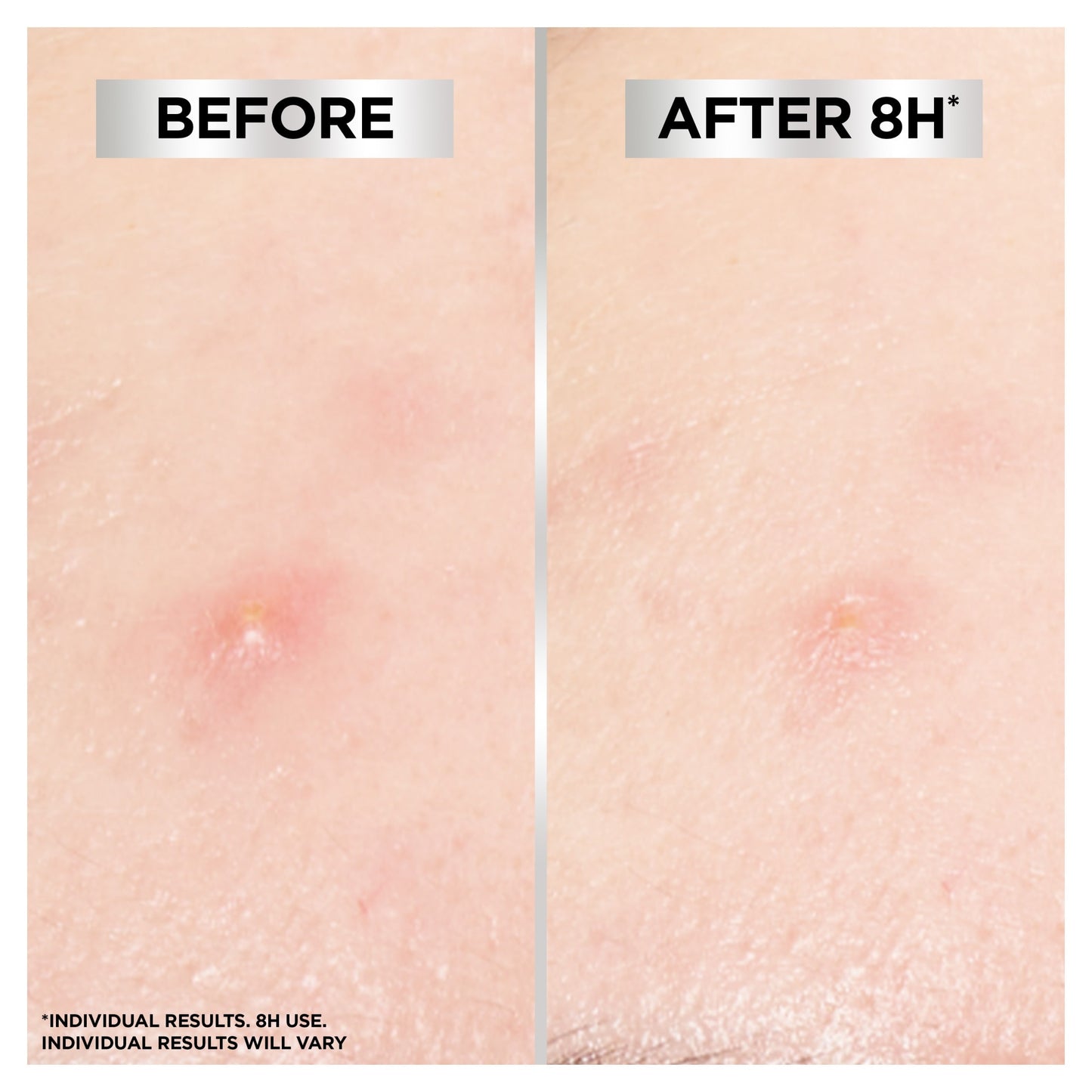 Garnier Pure Active Blemish Patch 22 Pack — image 5