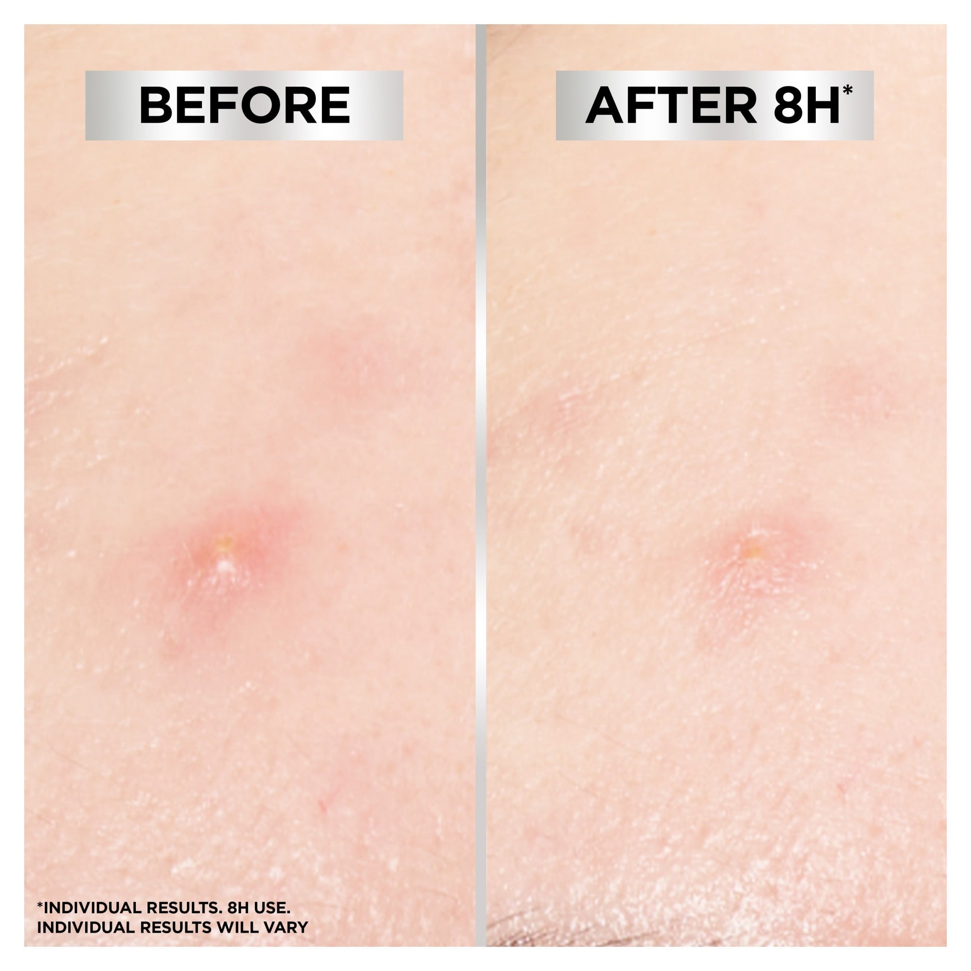 Garnier Pure Active Blemish Patch 22 Pack — image 5