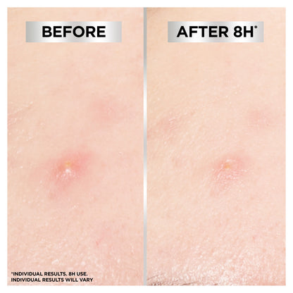 Garnier Pure Active Blemish Patch 22 Pack — image 5